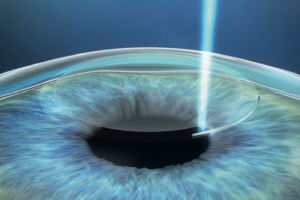 A Smile kezelésről bővebben