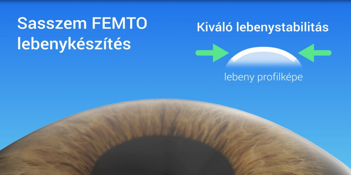 Sasszem No-touch PRK egylézeres kezelés Sasszem Femto7D kétlézeres kezelés